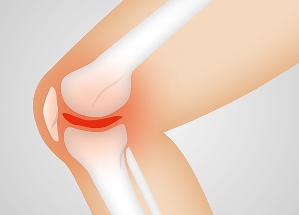 anterior cruciate ligament injuries