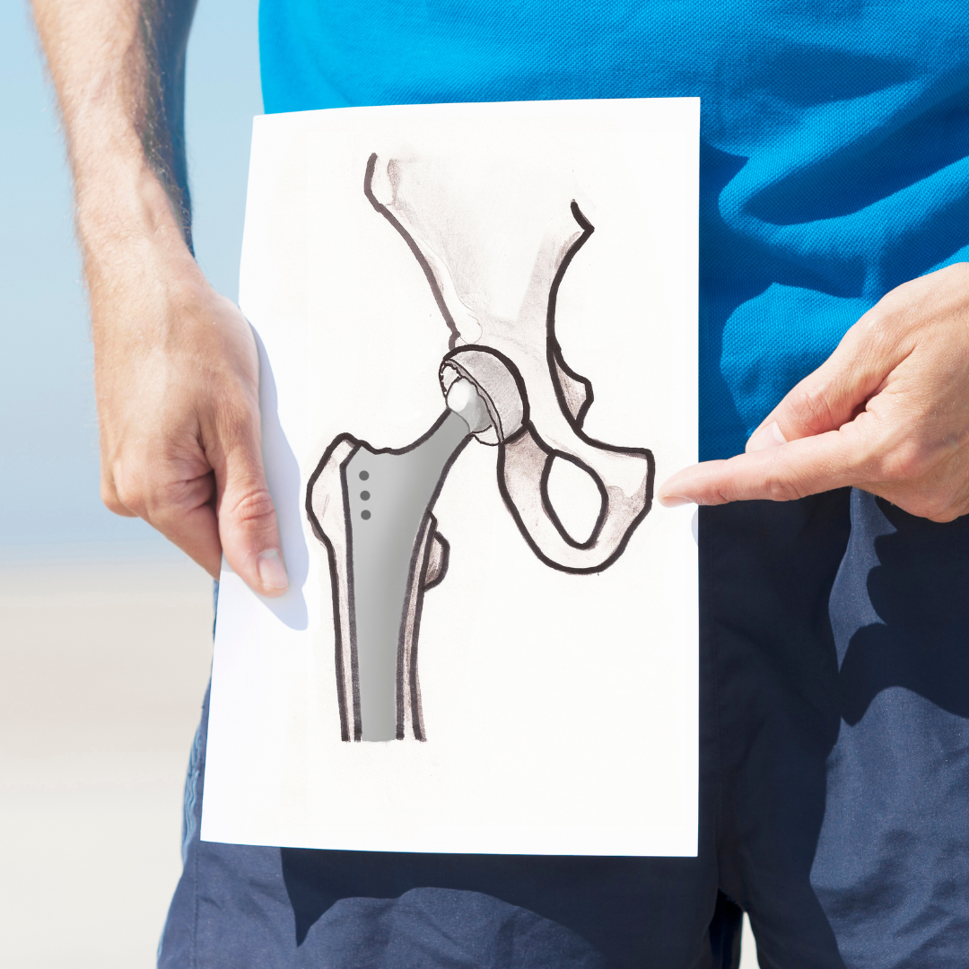 Hip Replacement Recovery Timeline: Walking, Driving and Daily Life