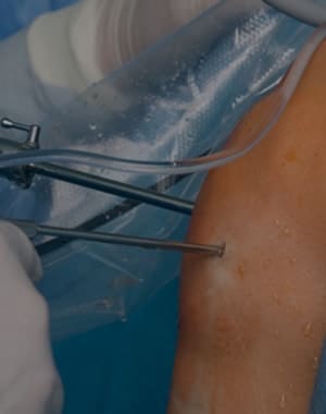 Arthroscopic Surgery