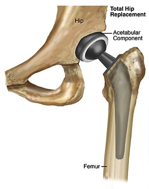 Hip Replacement